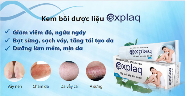 Kem bôi Explaq giúp cải thiện bệnh vảy nến